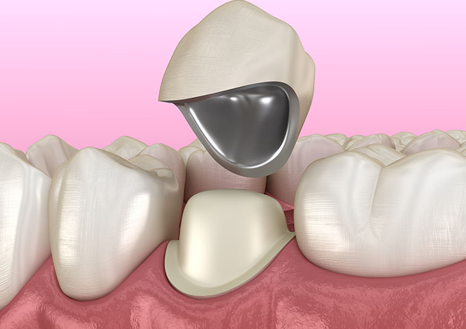 Porcelain crowns